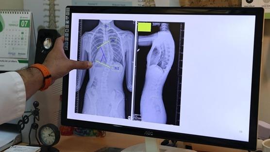 Çocuklarda ergenlik öncesi skolyoz kontrolü tedavi şansını artırıyor