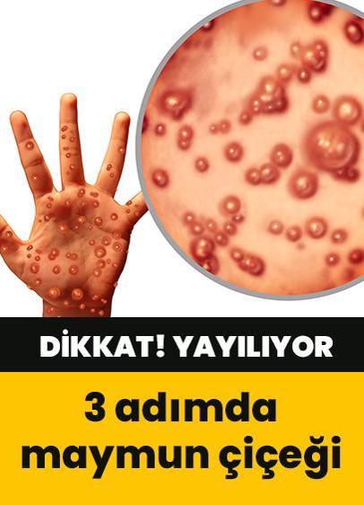 3 adımda maymun çiçeği belirtileri! Çiçek hastalığıyla karıştırmayın