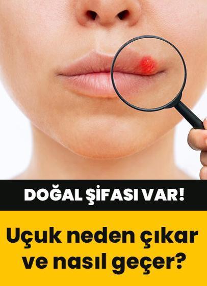 Uçuk neden çıkar ve nasıl geçer? İşte sebepleri ve tedavi yöntemleri