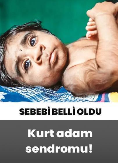 Bebeklerde Kurt adam sendromu! Sebebi ebeveynlerin saç spreyi!