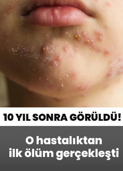 10 yıl sonra ülkede görüldü! O hastalıktan ilk ölüm gerçekleşti