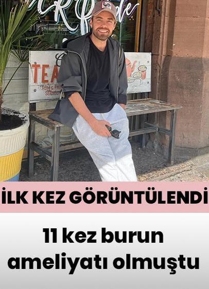 Murat Dalkılıç 11. burun ameliyatının ardından ilk kez paylaşım yaptı