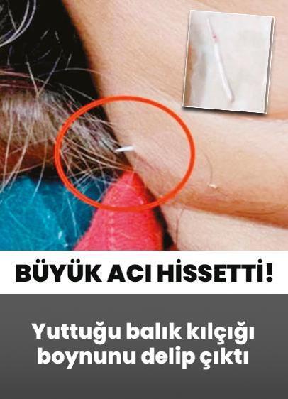 Yuttuğu balık kılçığı boynunu delip çıktı