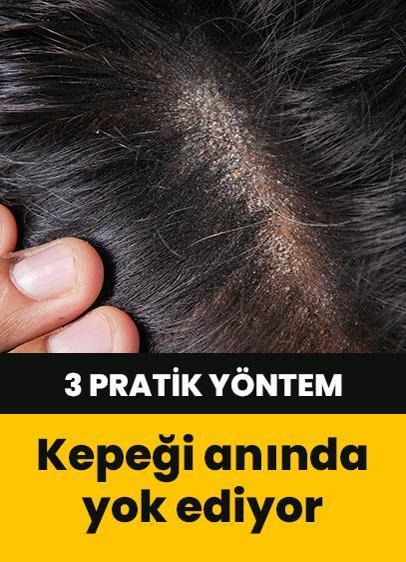 Kepeği yok etmek mümkün! Evde uygulanabilecek 3 pratik yöntem