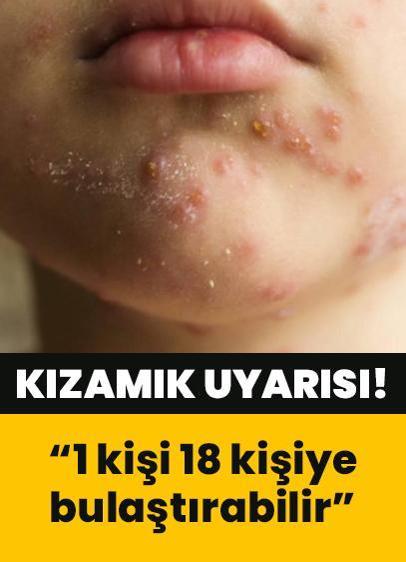 Uzmanından "kızamık" uyarısı! Prof. Dr. Ateş Kara: 1 kişi 18 kişiye bulaştırabilir