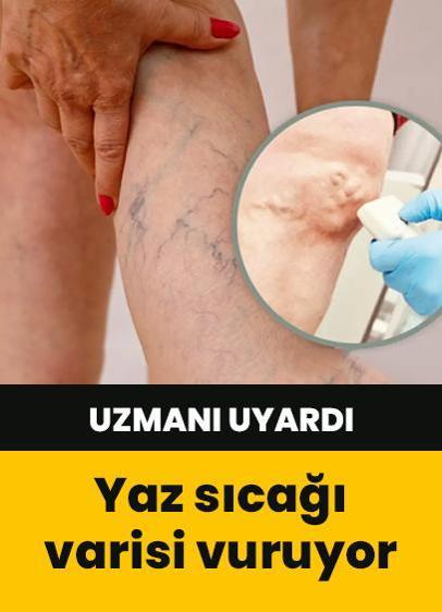Yaz sıcağı varisi vuruyor!